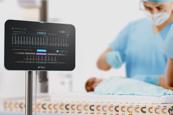 Neonav® ECG Tip Location System in a neonatal clinical setting. Developed by Navi Medical Technologies, Neonav uses real-time intravascular ECG to support central venous access device tip placement and ongoing migration surveillance.